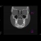 Fibrous dysplasia of the mandible: CT - Computed tomography